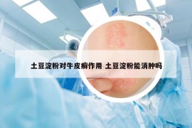 土豆淀粉對(duì)牛皮癬作用 土豆淀粉能消腫嗎