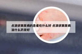 點(diǎn)滴狀銀屑病的患者吃什么好 點(diǎn)滴狀銀屑病涂什么藥膏好
