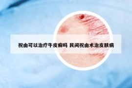 祝由可以治療牛皮癬嗎 民間祝由術(shù)治皮膚病
