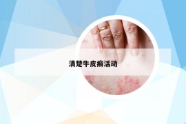清楚牛皮癬活動(dòng)