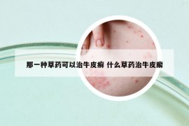 那一種草藥可以治牛皮癬 什么草藥治牛皮廨