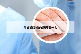 牛皮癬發(fā)病的原因是什么