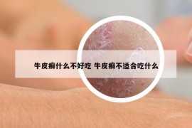 牛皮癬什么不好吃 牛皮癬不適合吃什么