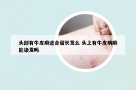 頭部有牛皮癬適合留長發(fā)么 頭上有牛皮病癬能染發(fā)嗎