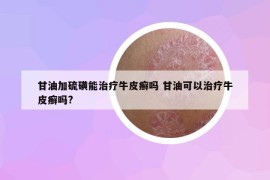 甘油加硫磺能治療牛皮癬嗎 甘油可以治療牛皮癬嗎?