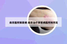 南京醫(yī)院銀屑病 南京治療銀屑病醫(yī)院如何走