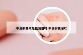 牛皮癬變紅是在消退嗎 牛皮癬變深紅