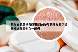 男友有銀屑病我還要嫁給他嗎 男朋友得了銀屑病還能跟他在一起嗎