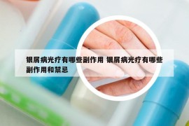 銀屑病光療有哪些副作用 銀屑病光療有哪些副作用和禁忌