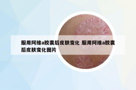 服用阿維a膠囊后皮膚變化 服用阿維a膠囊后皮膚變化圖片