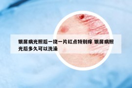 銀屑病光照后一撓一片紅點(diǎn)特別癢 銀屑病照光后多久可以洗澡