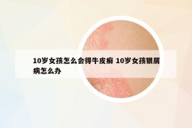 10歲女孩怎么會(huì)得牛皮癬 10歲女孩銀屑病怎么辦
