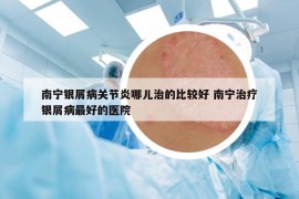 南寧銀屑病關(guān)節(jié)炎哪兒治的比較好 南寧治療銀屑病最好的醫(yī)院