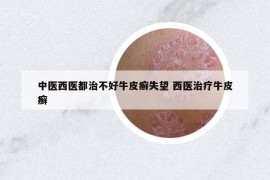 中醫(yī)西醫(yī)都治不好牛皮癬失望 西醫(yī)治療牛皮癬