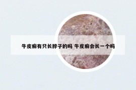 牛皮癬有只長脖子的嗎 牛皮癬會長一個(gè)嗎