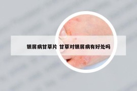 銀屑病甘草片 甘草對銀屑病有好處嗎