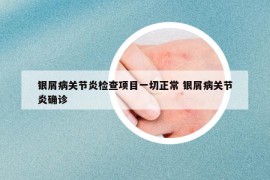 銀屑病關節(jié)炎檢查項目一切正常 銀屑病關節(jié)炎確診