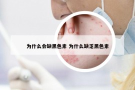 為什么會缺黑色素 為什么缺乏黑色素