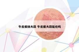 牛皮癬抹大蒜 牛皮廨大蒜能吃嗎