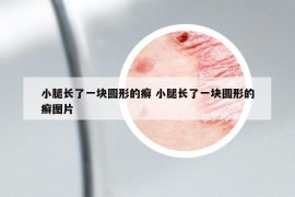 小腿長了一塊圓形的癬 小腿長了一塊圓形的癬圖片