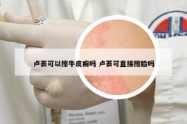 盧薈可以擦牛皮癬嗎 盧薈可直接擦臉嗎