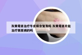 灰黃霉素治療牛皮癬會復(fù)發(fā)嗎 灰黃霉素片能治療銀屑病的嗎