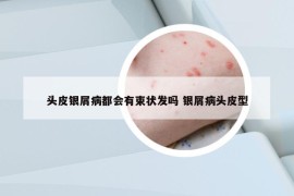 頭皮銀屑病都會有束狀發(fā)嗎 銀屑病頭皮型