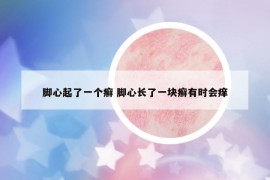 腳心起了一個(gè)癬 腳心長(zhǎng)了一塊癬有時(shí)會(huì)癢
