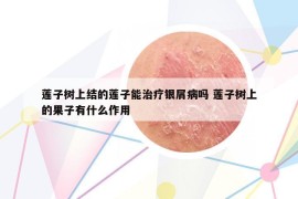 蓮子樹(shù)上結(jié)的蓮子能治療銀屑病嗎 蓮子樹(shù)上的果子有什么作用