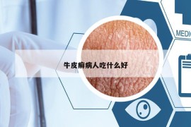 牛皮癬病人吃什么好