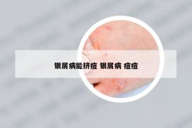 銀屑病能擠痘 銀屑病 痘痘