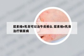 尿素維e乳膏可以治牛皮癬么 尿素維e乳膏治療銀屑病