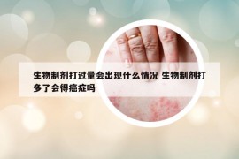 生物制劑打過量會出現(xiàn)什么情況 生物制劑打多了會得癌癥嗎