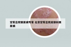 空軍總院銀屑病專家 北京空軍總院皮膚科銀屑病