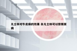 凡士林對牛皮癬的效果 白凡士林可以擦銀屑病