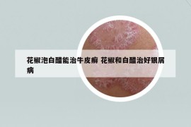 花椒泡白醋能治牛皮癬 花椒和白醋治好銀屑病