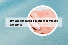 南寧治療牛皮癬病哪個(gè)醫(yī)院最好 南寧哪里治皮膚病厲害