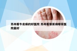 蘇州看牛皮癬的好醫(yī)院 蘇州看銀屑病哪家醫(yī)院最好