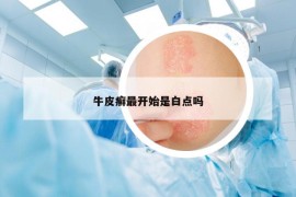 牛皮癬最開始是白點嗎