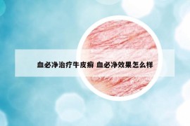 血必凈治療牛皮癬 血必凈效果怎么樣
