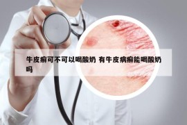 牛皮癬可不可以喝酸奶 有牛皮病癬能喝酸奶嗎