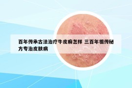 百年傳承古法治療牛皮癬怎樣 三百年祖?zhèn)髅胤綄Ｖ纹つw病