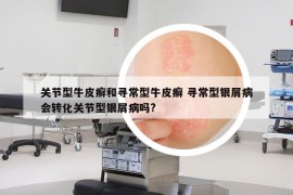 關(guān)節(jié)型牛皮癬和尋常型牛皮癬 尋常型銀屑病會(huì)轉(zhuǎn)化關(guān)節(jié)型銀屑病嗎?