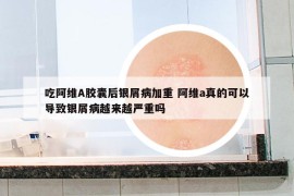 吃阿維A膠囊后銀屑病加重 阿維a真的可以導(dǎo)致銀屑病越來越嚴(yán)重嗎