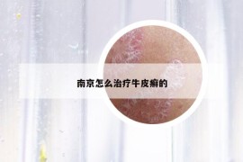 南京怎么治療牛皮癬的