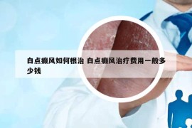 白點(diǎn)癲風(fēng)如何根治 白點(diǎn)癲風(fēng)治療費(fèi)用一般多少錢