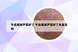 牛皮癬抹蘆薈好了 牛皮癬抹蘆薈好了會復(fù)發(fā)嗎