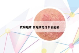 皮癬皰疹 皮皰疹是什么引起的