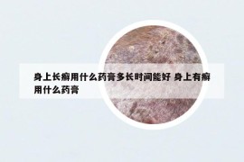 身上長癬用什么藥膏多長時間能好 身上有癬用什么藥膏
