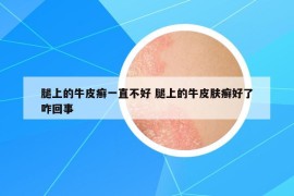 腿上的牛皮癬一直不好 腿上的牛皮膚癬好了咋回事